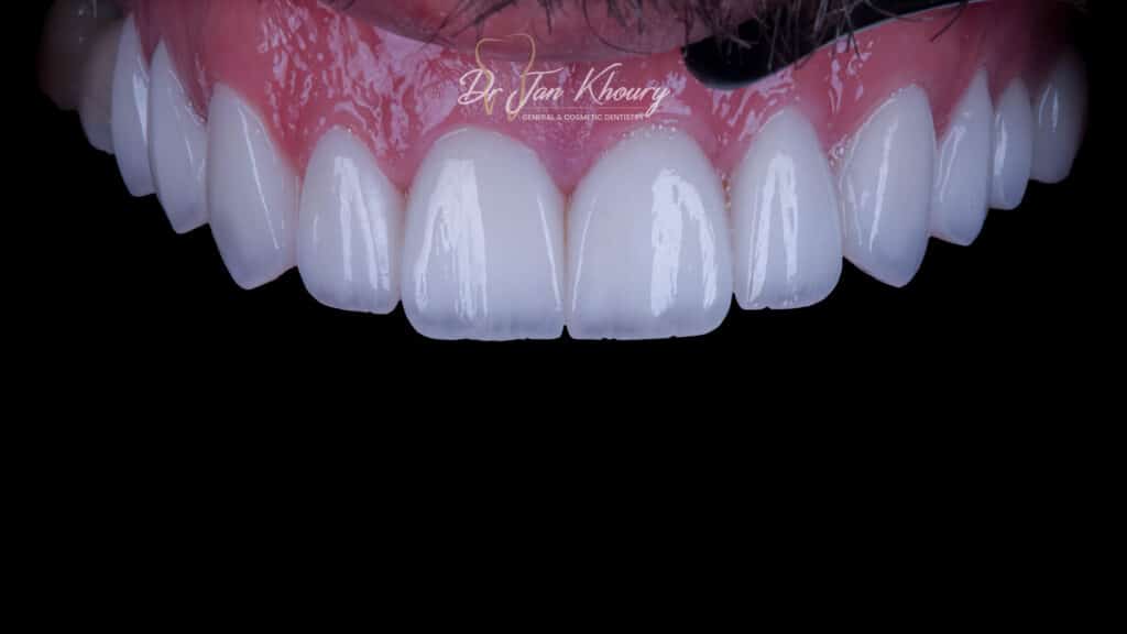 ציפויי שיניים