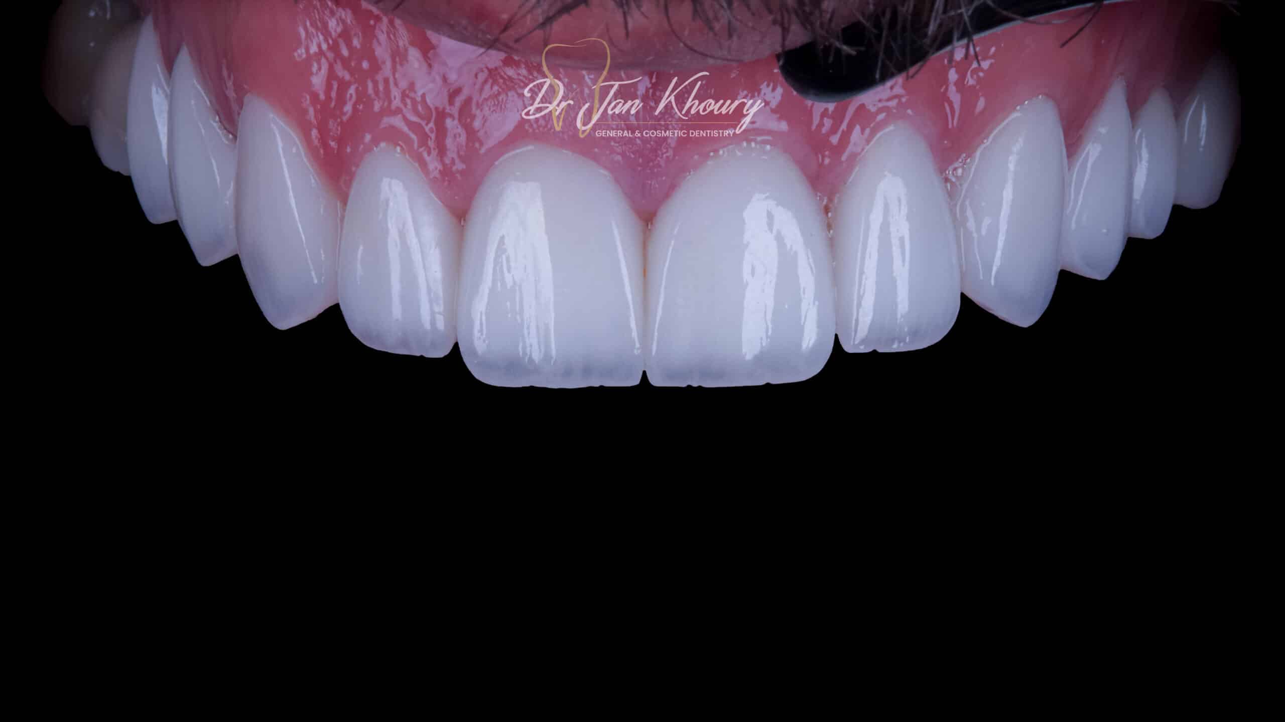 ציפויי שיניים