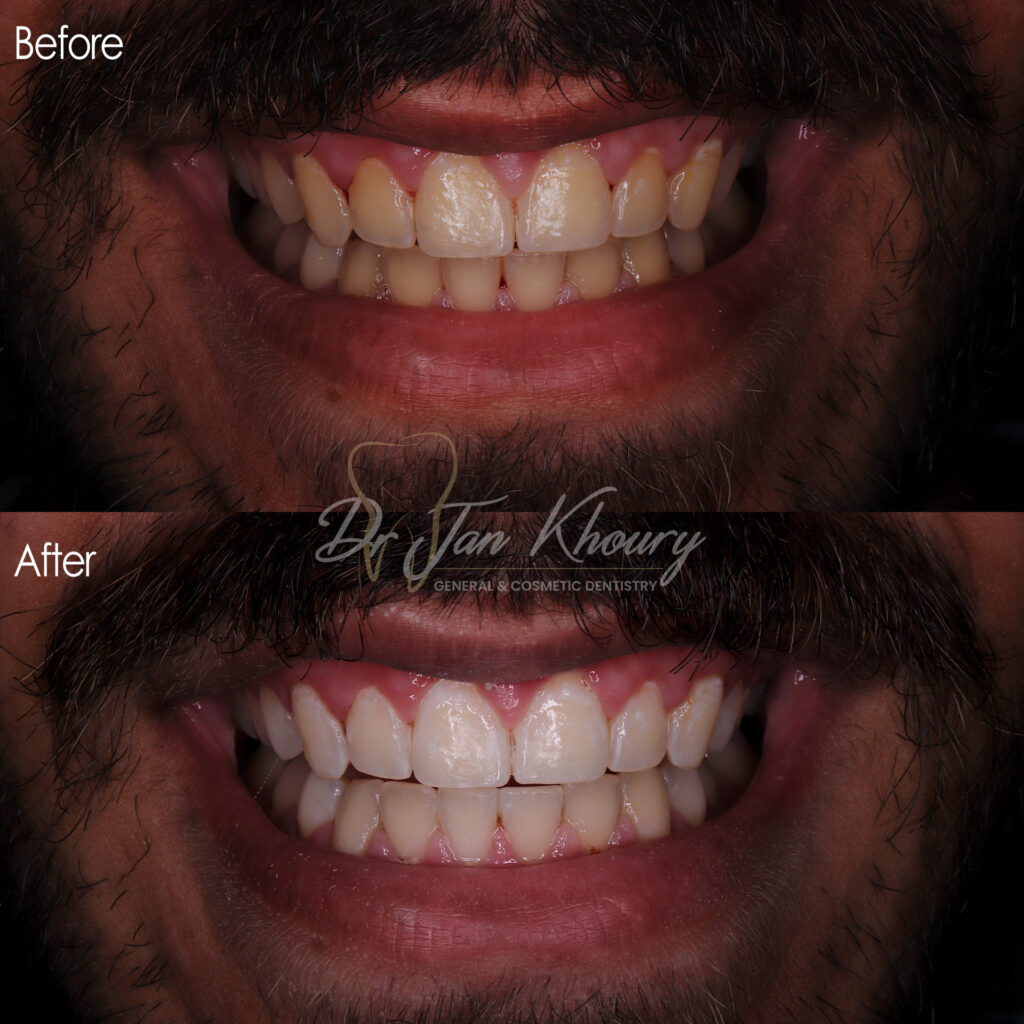 הלבנת שיניים