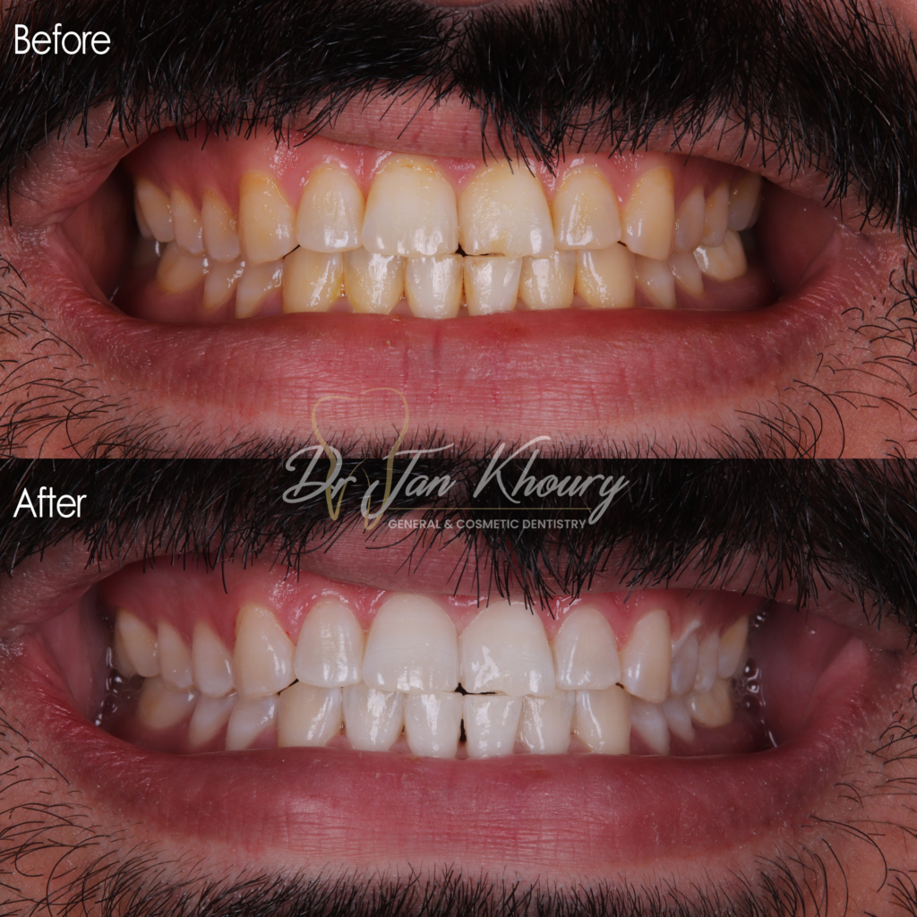 הלבנת שיניים